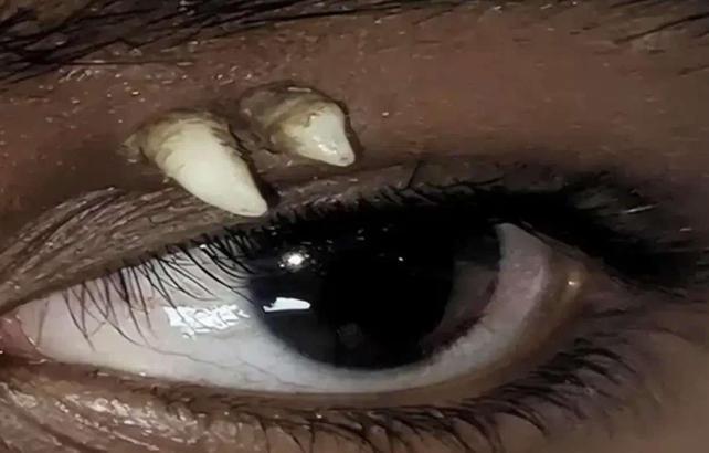 Tıp d&uuml;nyasını şaşkına uğrattı! 16 yaşındaki &ccedil;ocuğun g&ouml;z kapağındaki şişlik diş &ccedil;ıktı