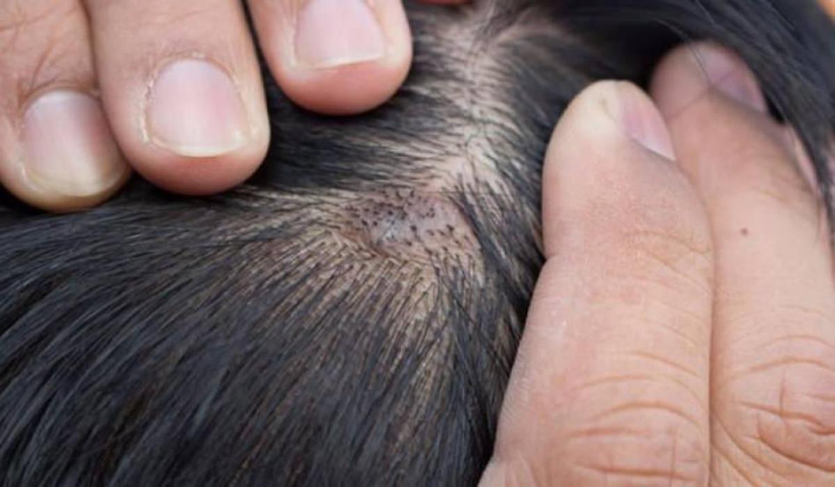 kafa derisinde neden sivilce cikar kafa derisindeki sivilceler nasil gecer guzellik haberleri