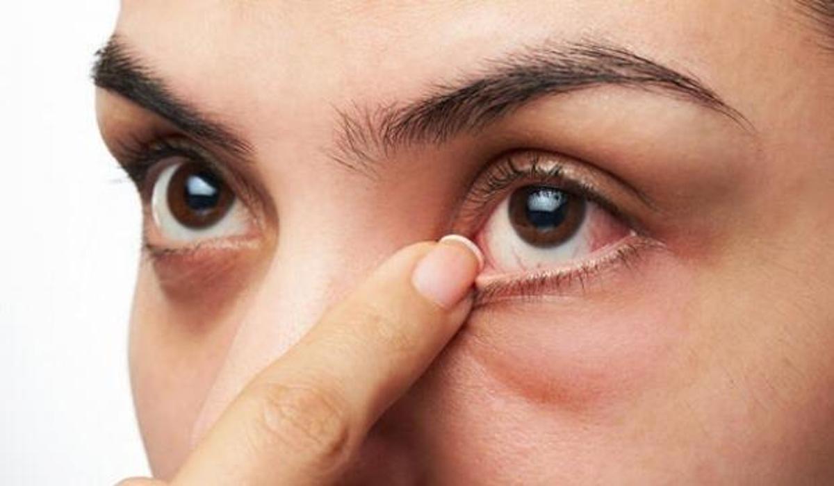 gozlerde kizariklik varsa dikkat koronavirus isareti olabilir guncel haberleri