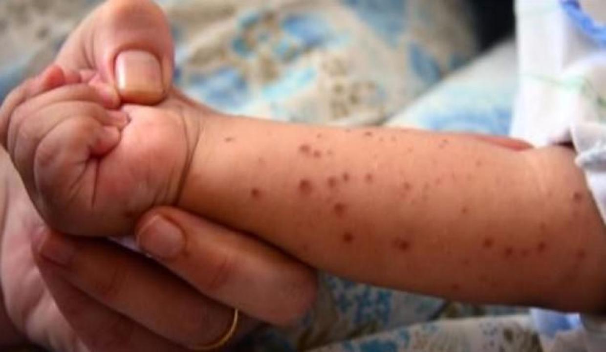 bebeklerde kirmizi dokuntuler bebek arabasi