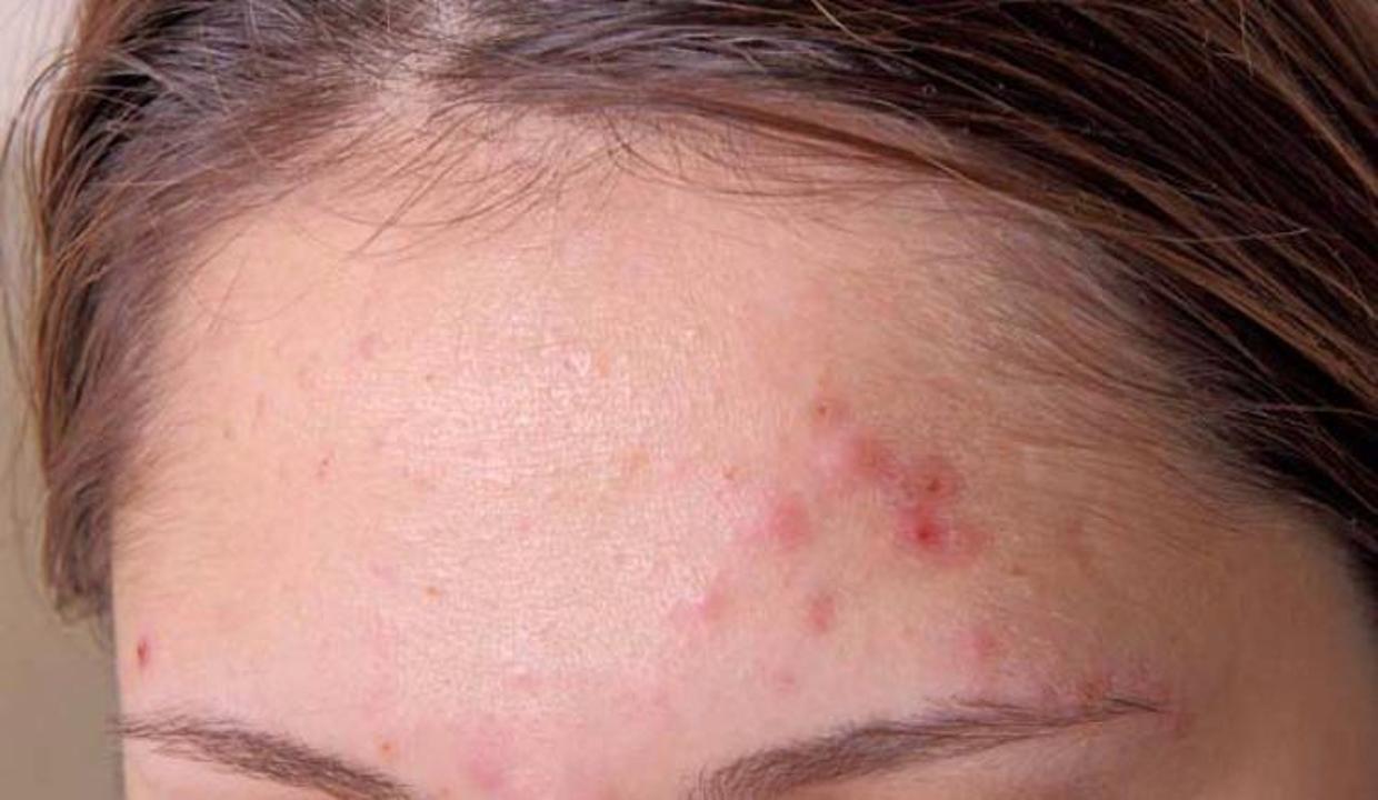 Sivilceleriniz Ne Anlama Geliyor Bakim Haberleri Sivilceleriniz Ne Anlama Geliyor Bakim Haberleri