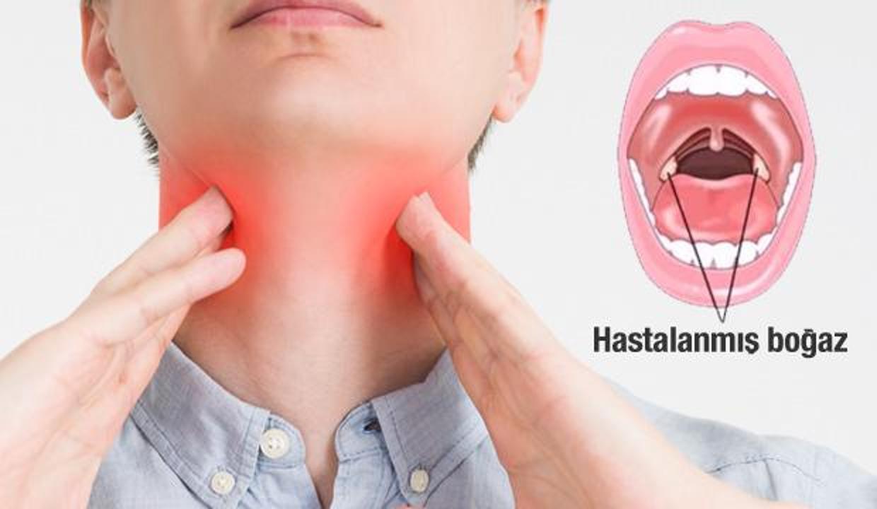 bogaz agrisina ne iyi gelir evde dogal yontemlerle bogaz agrisi nasil gecer saglik haberleri