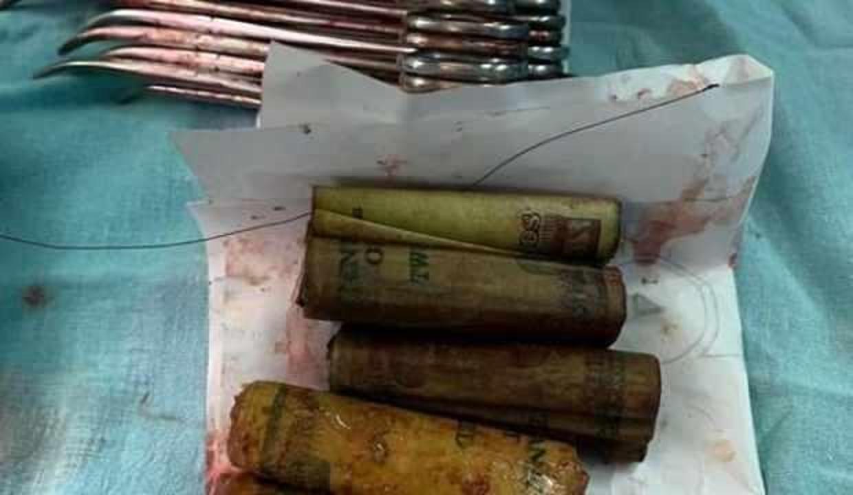 Midesinden tomarla para çıktı! Gerçek ortaya çıkınca inanamadılar