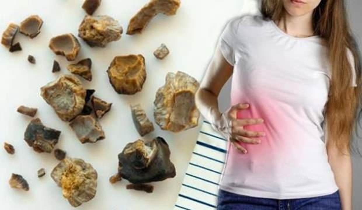 Her 10 kişiden 1'inde mutlaka görülüyor! Taş hastalığı nedir?