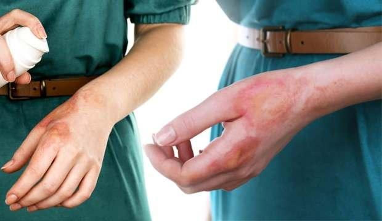 Yanık vakalarında ilk müdahale nasıl olmalı? Diş macunu sürmek doğru mu?