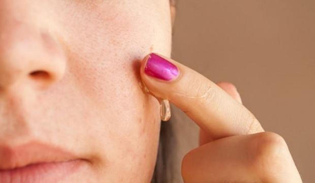 Sivilce izleri nasıl geçer? Sivilce patlatmak zararlı mı? Sivilce izlerine doğal tedavi yöntemi