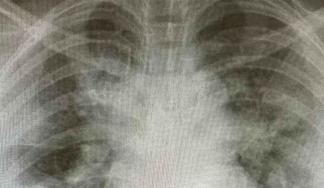 Röntgenler paylaşıldı! Yoğun bakımlar gençlerle dolu