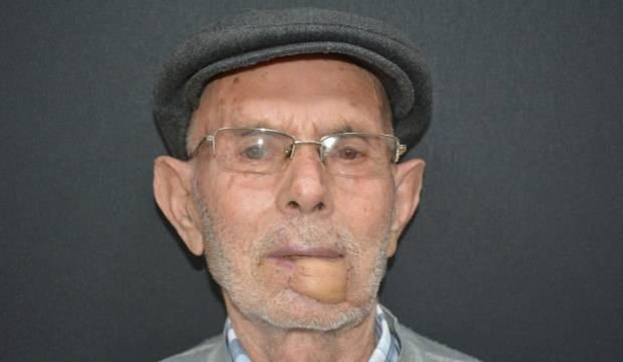 Bilecik'te kanserden dudağını kaybeden hastaya yeni dudak yapıldı