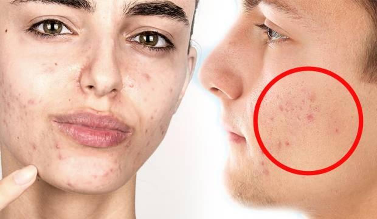 Maske kullanımıyla artışa geçen cilt hastalıklarına dikkat!