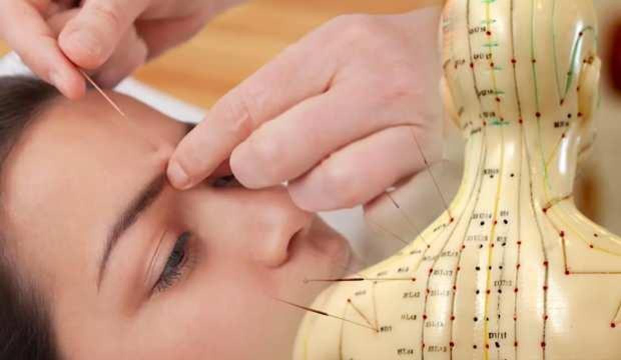 Akupunktur yaptırmanın faydaları nelerdir? Akupunktur nedir, zararları nelerdir?
