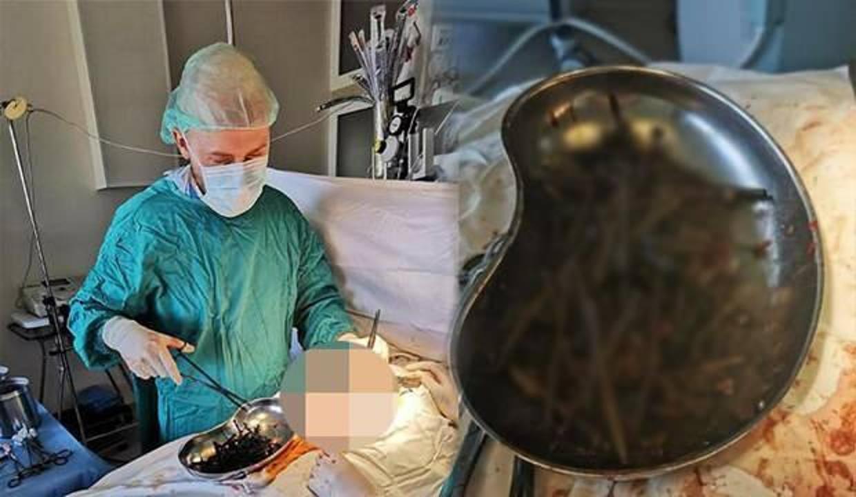 Doktorlar şok oldu! Hastanın midesinden 1 kilogramdan fazla çivi, vida ve bıçak çıkarıldı