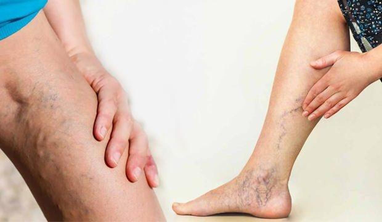Varis tedavisi için en doğru zaman kış ayları