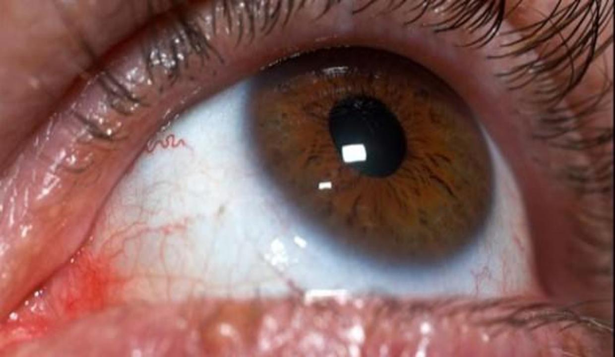 Kornea Naklinde Ameliyat Sonrasi Onemli Genel Saglik Haberleri Kornea Naklinde Ameliyat Sonrasi Onemli Genel Saglik Haberleri