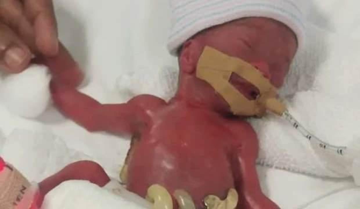 212 gram doğan bebek, 13 aylık yaşam savaşının sonunda