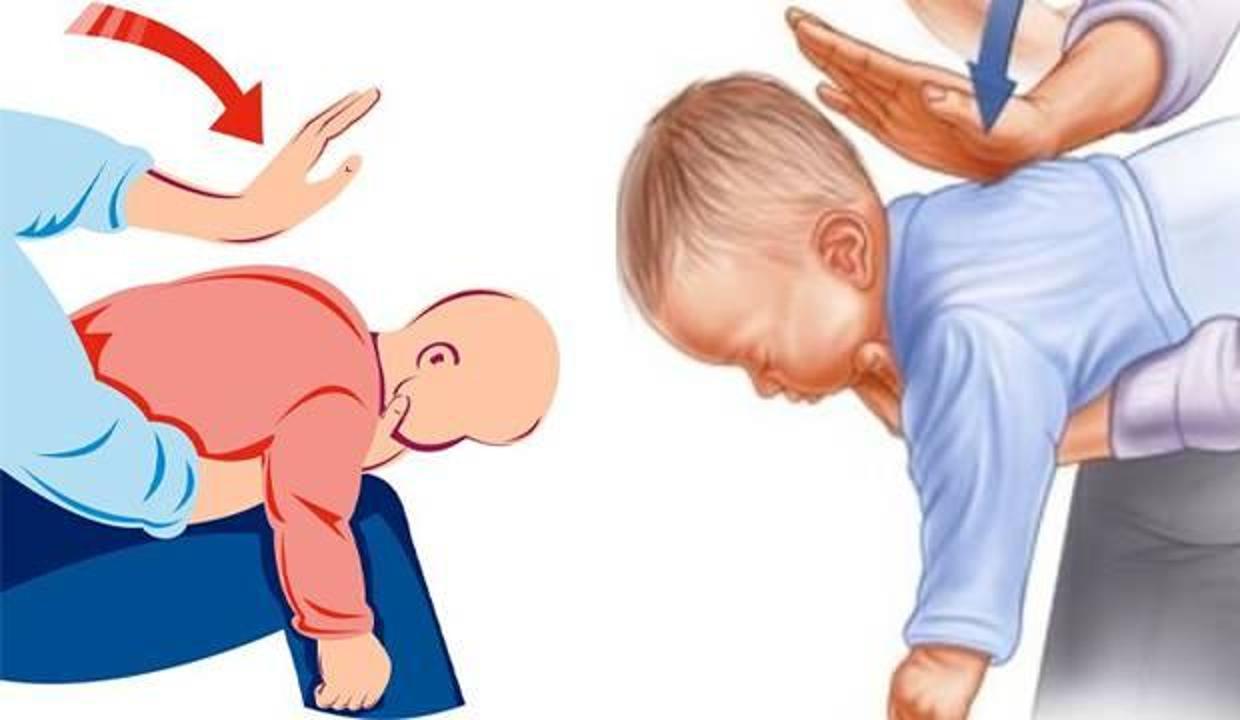 �Heimlich manevrası� özellikle 1 yaş altı çocukların