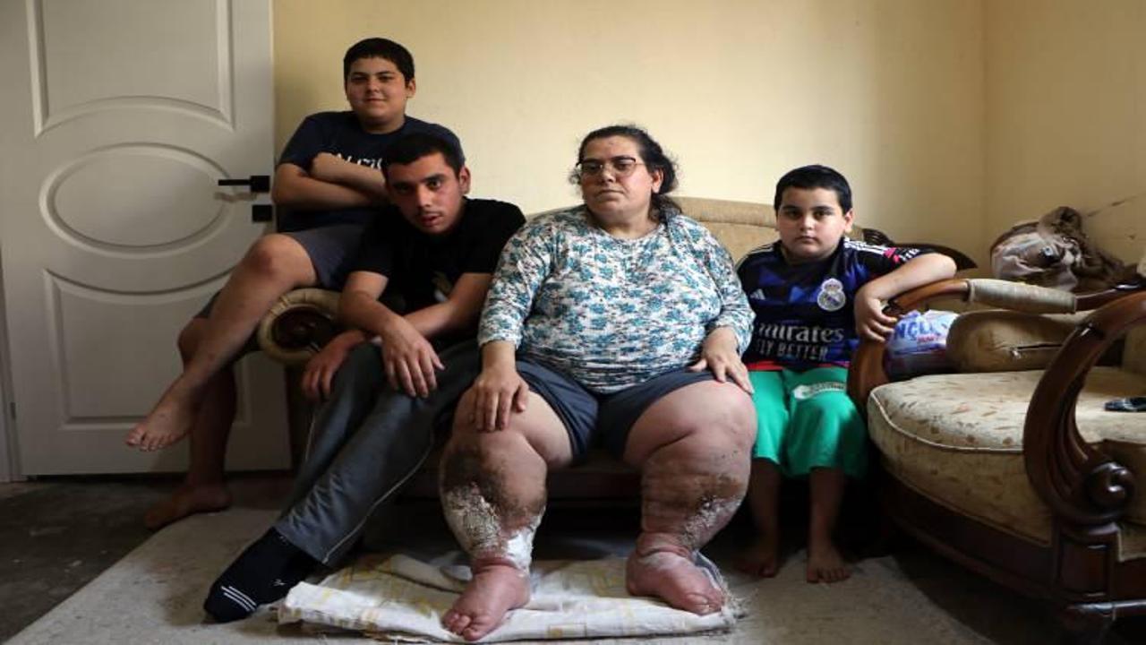 Fil hastası annenin çaresiz çığlığı: Çocuklarım için yaşamak istiyorum Fil hastası annenin çaresiz çığlığı: Çocuklarım için yaşamak istiyorum
