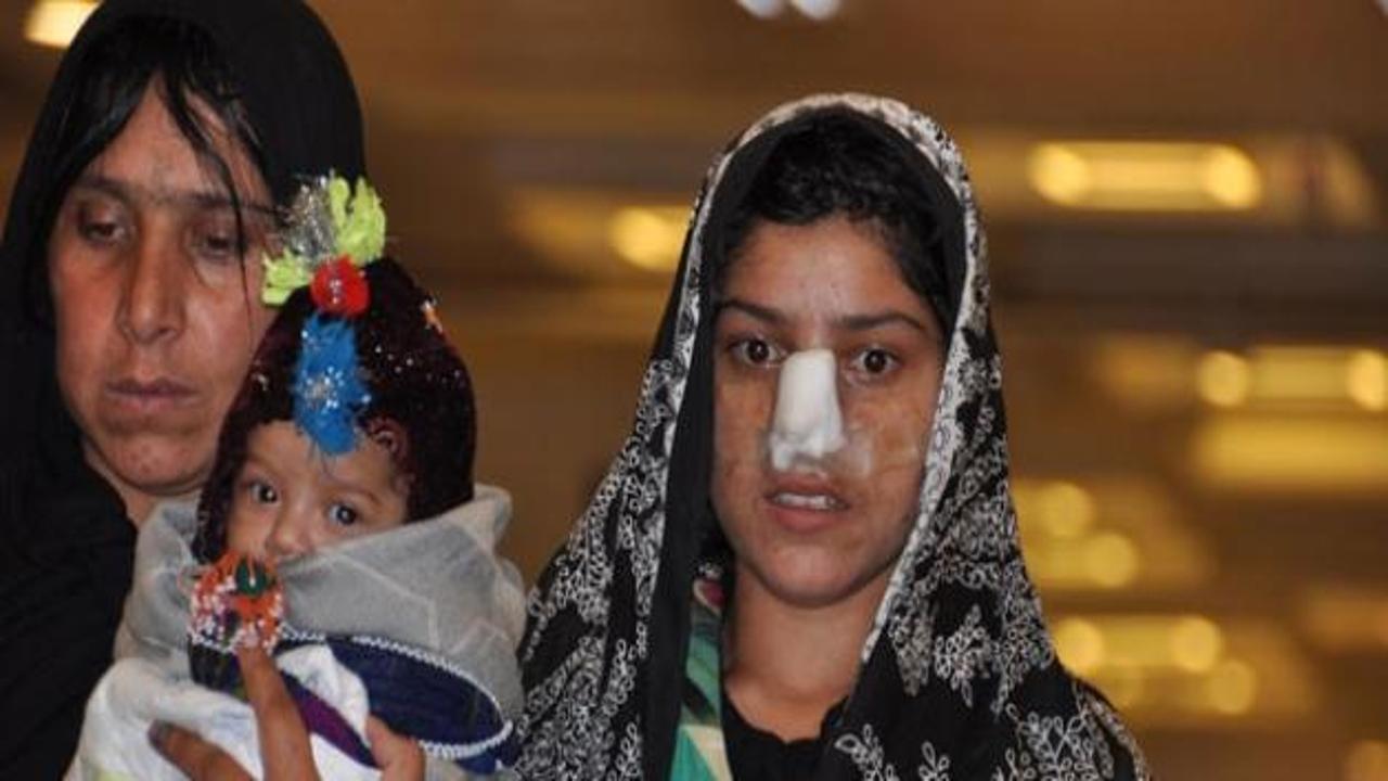 Burnu kesilen Afgan kadın tedavi için Türkiye'de