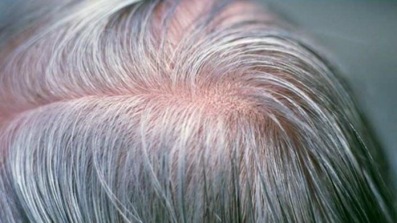 Saçların beyazlamasıyla bağlantılı gen bulundu