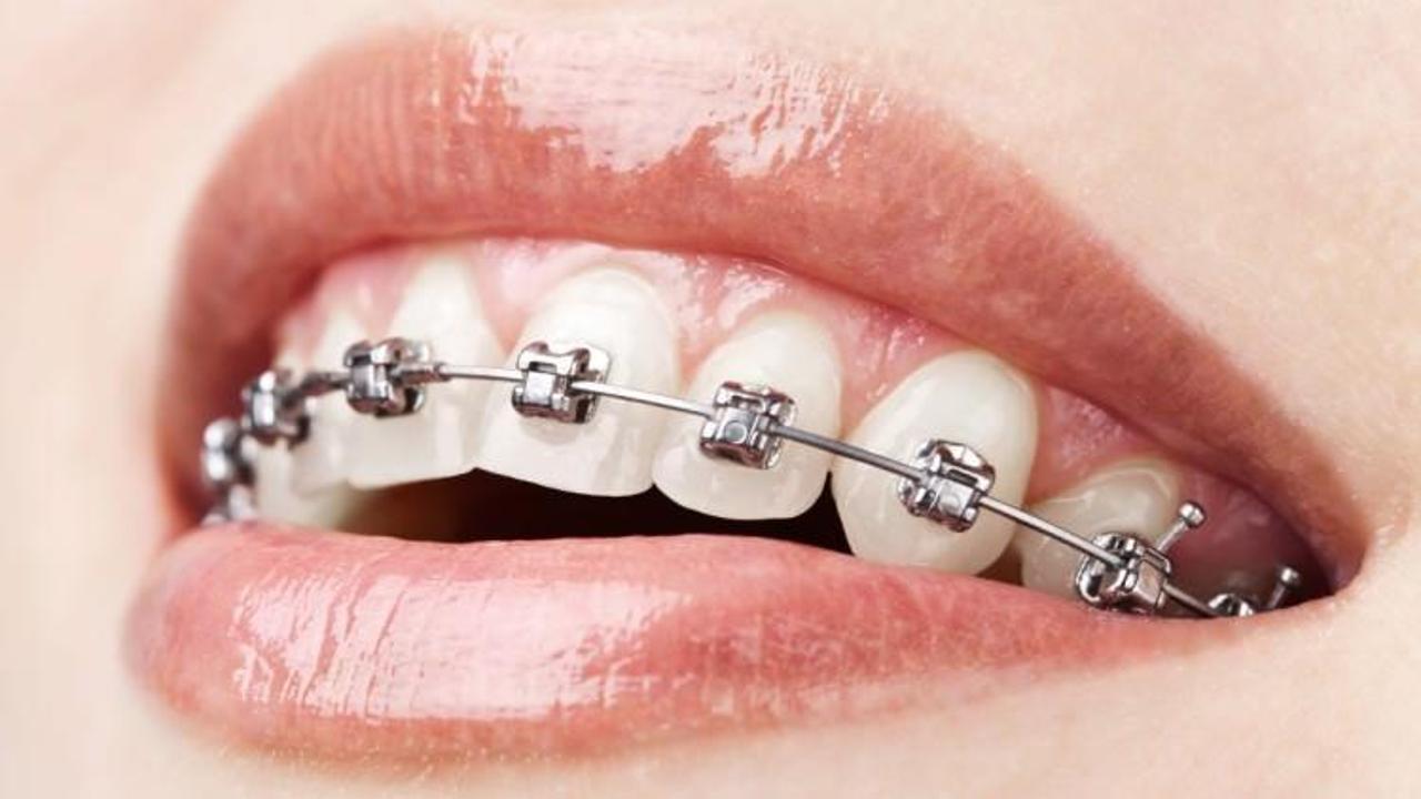 Diş teli tedavisinde doğru bilinen 5 yanlış
