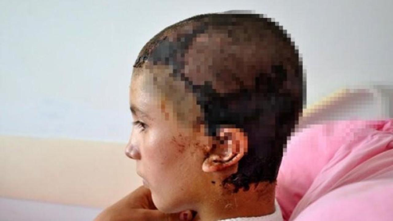 Kopan kafa derisi yerine dikildi