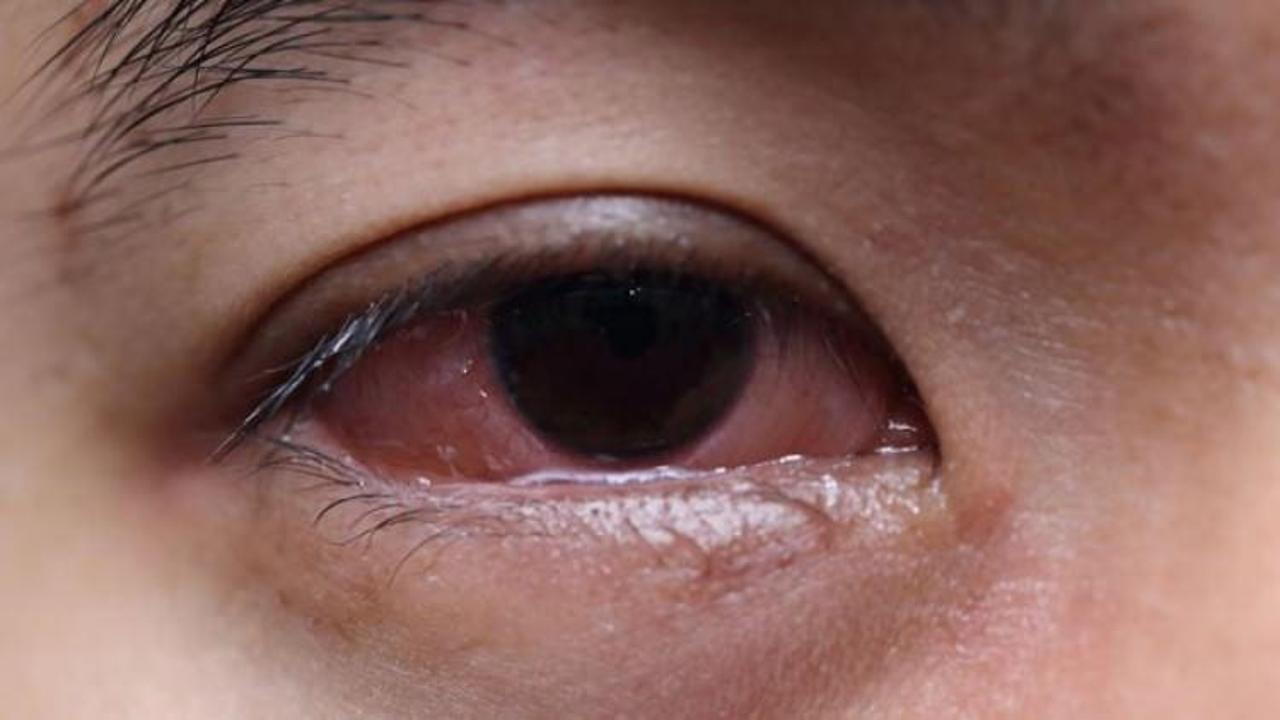 Göz alerjisi körlüğe sebep olabilir
