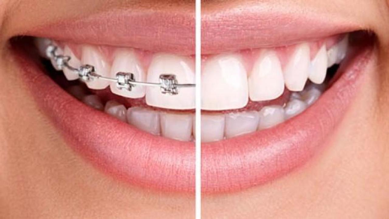 Estetik görünüm için diş teli şart mı?
