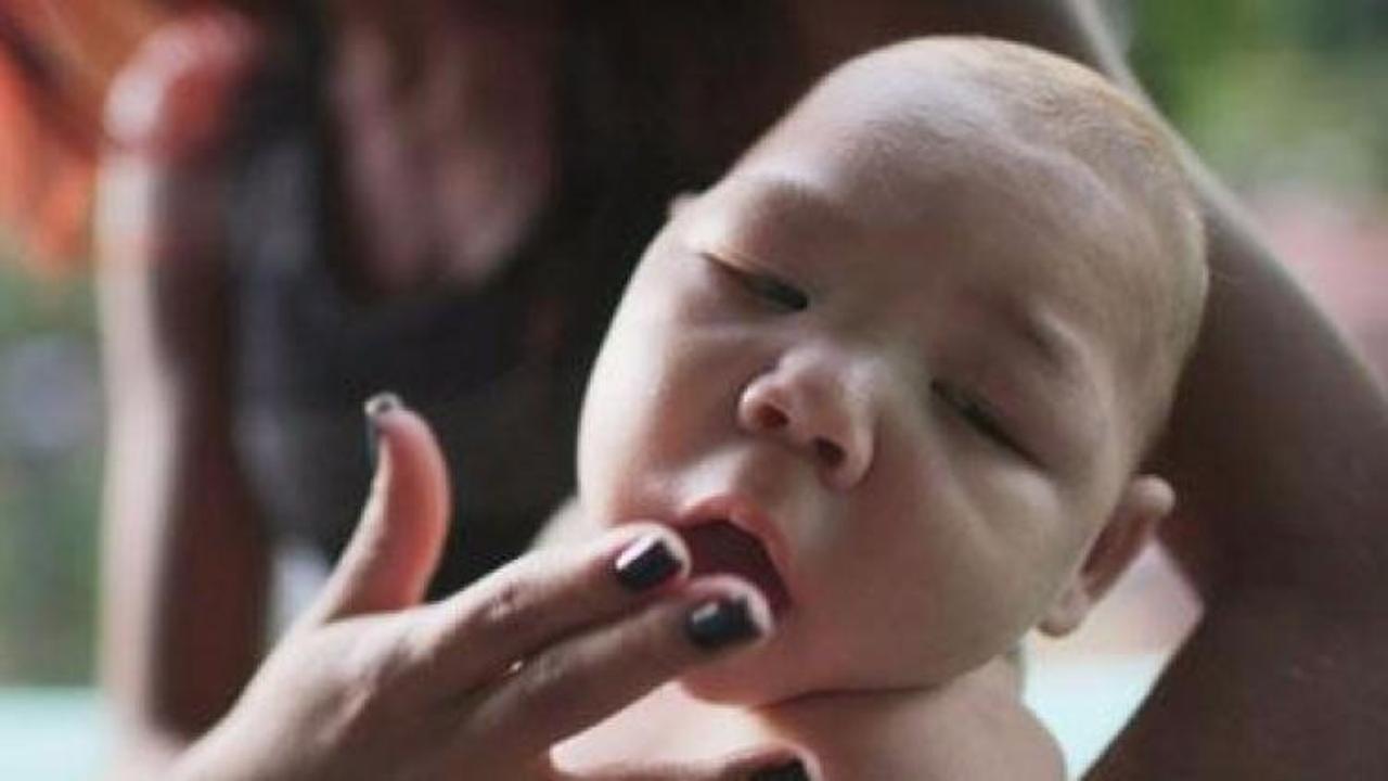 Zika vir&uuml;s&uuml; nedir ve belirtileri nelerdir?