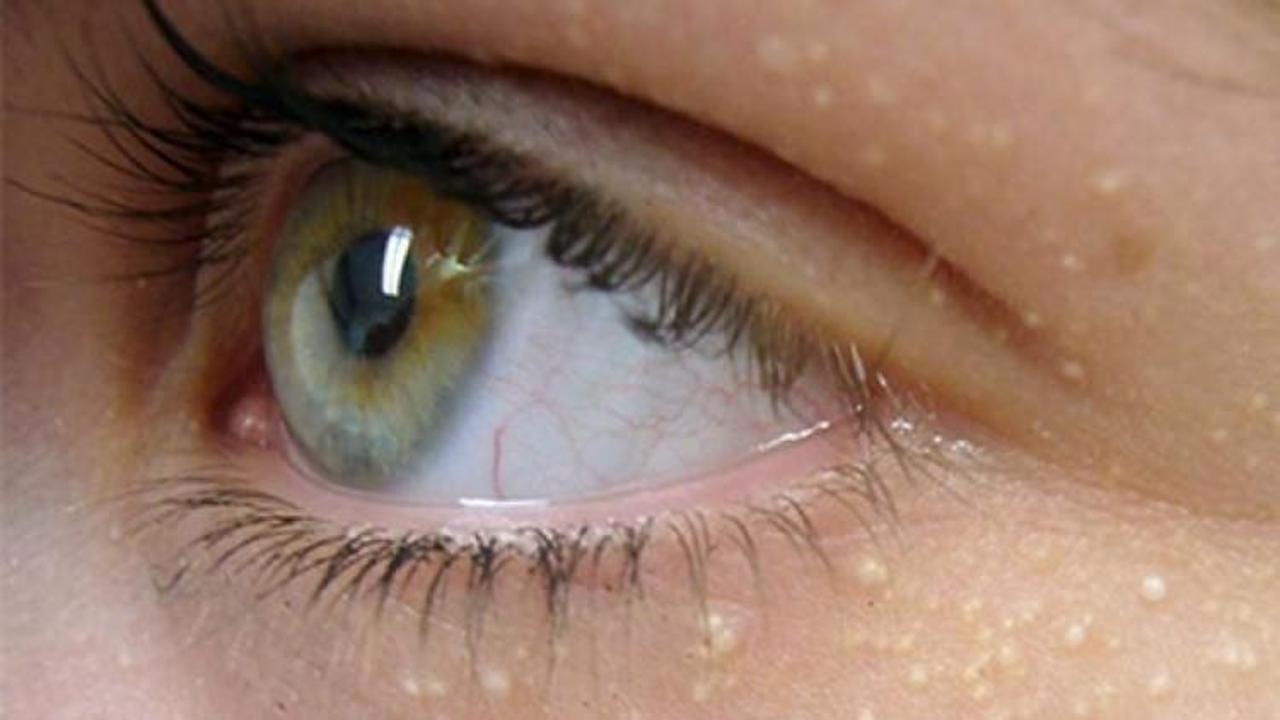 G&ouml;z &ccedil;evresindeki beyaz noktalar nasıl ge&ccedil;er?