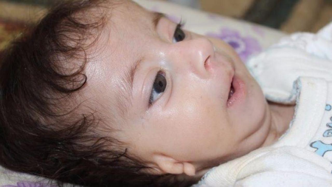 Kulakları olmayan bebek ameliyat olmayı bekliyor