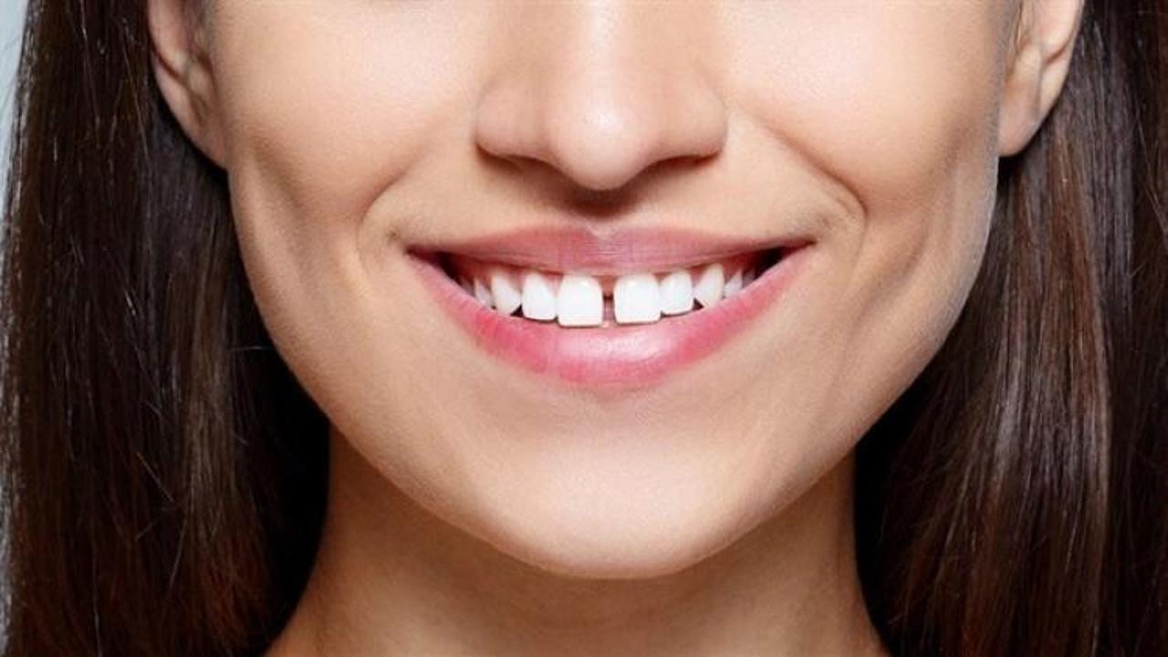 Aralıklı diş sahipleri dişlerini kaybedebilir