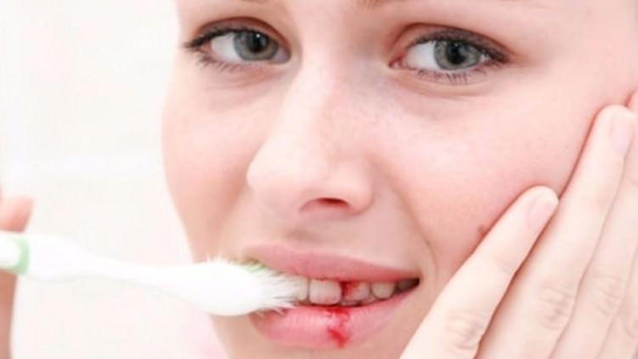 Diş eti kanamasına doğal &ccedil;&ouml;z&uuml;m