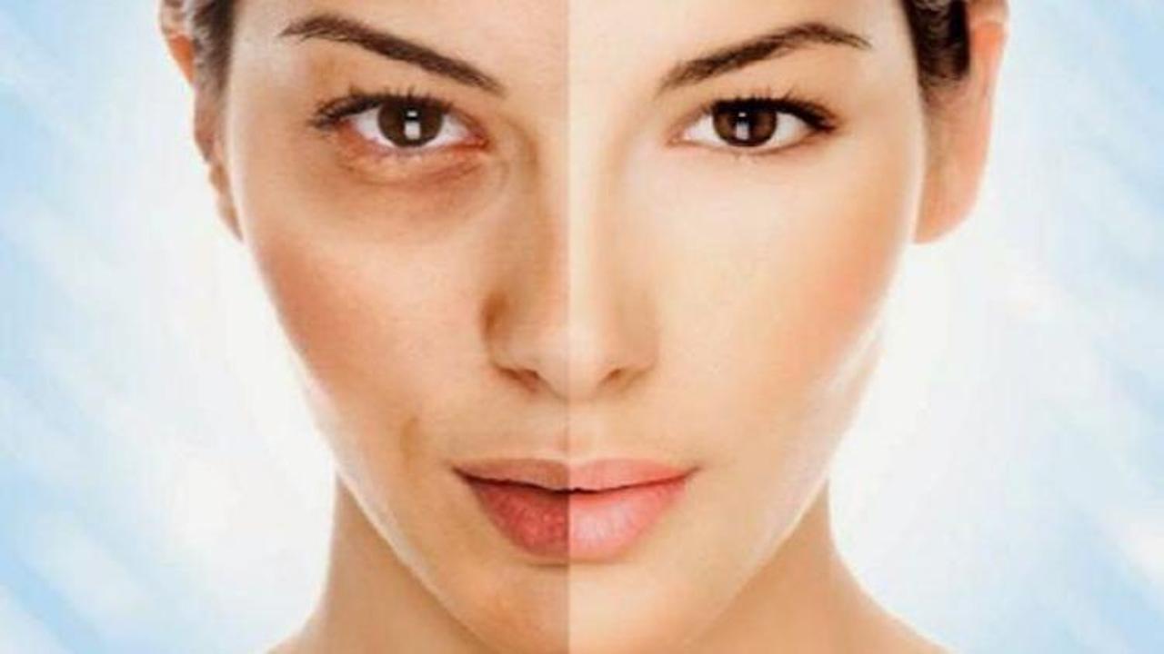 G&ouml;zaltı morluklarına doğal &ccedil;&ouml;z&uuml;m