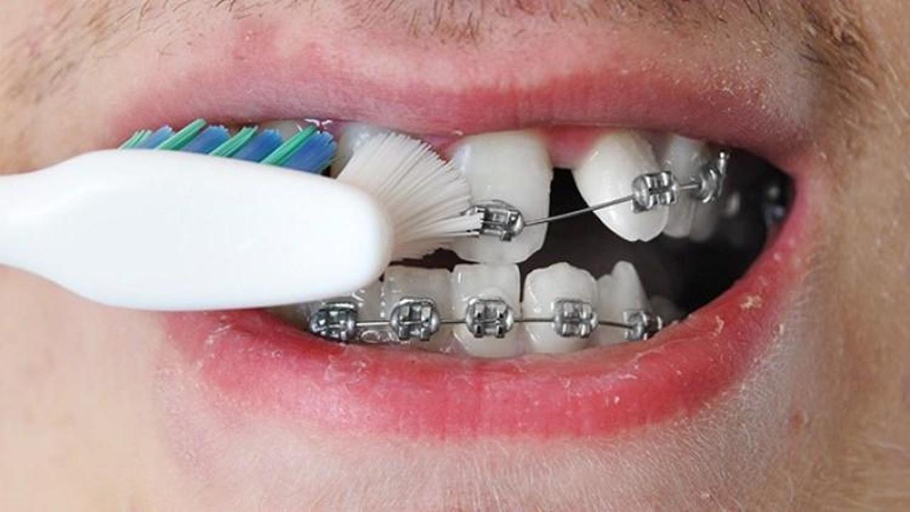 Diş teli olanlar nasıl diş fırçalamalılar? Diş teli için ağız bakım tüyoları