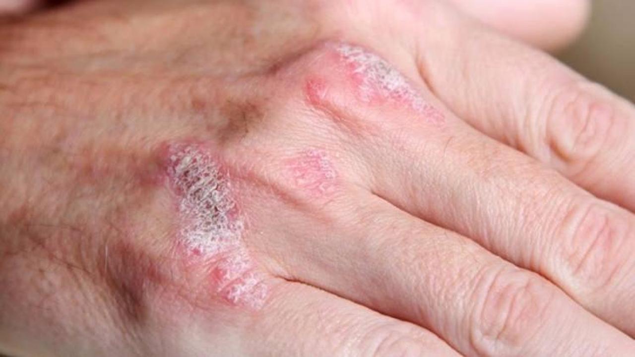 Sedef hastaları i&ccedil;in 'eklem romatizması' uyarısı