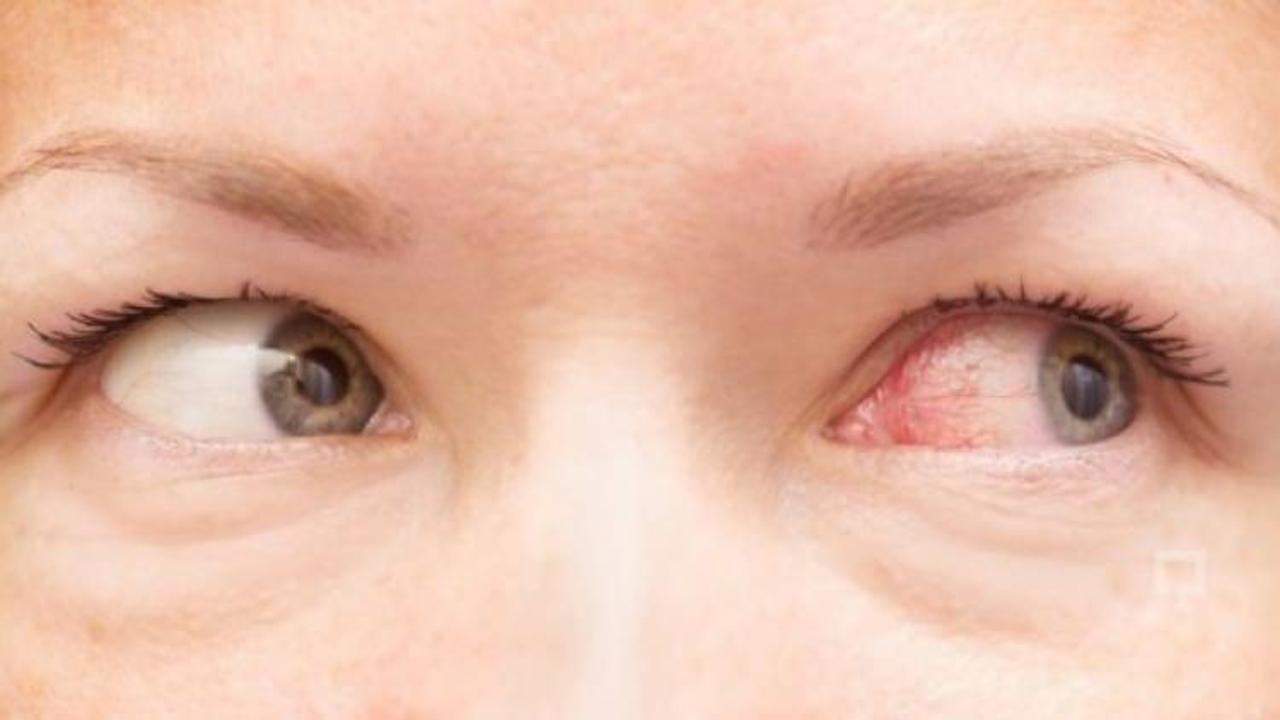 G&ouml;z kanlanması nasıl ge&ccedil;er?