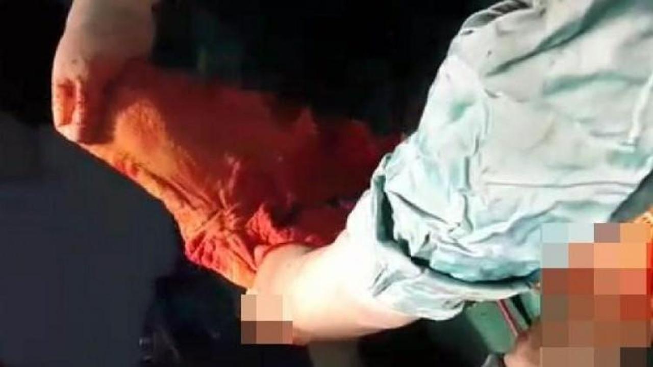 Trabzon'da şaşırtan olay! Karnından havlu &ccedil;ıktı