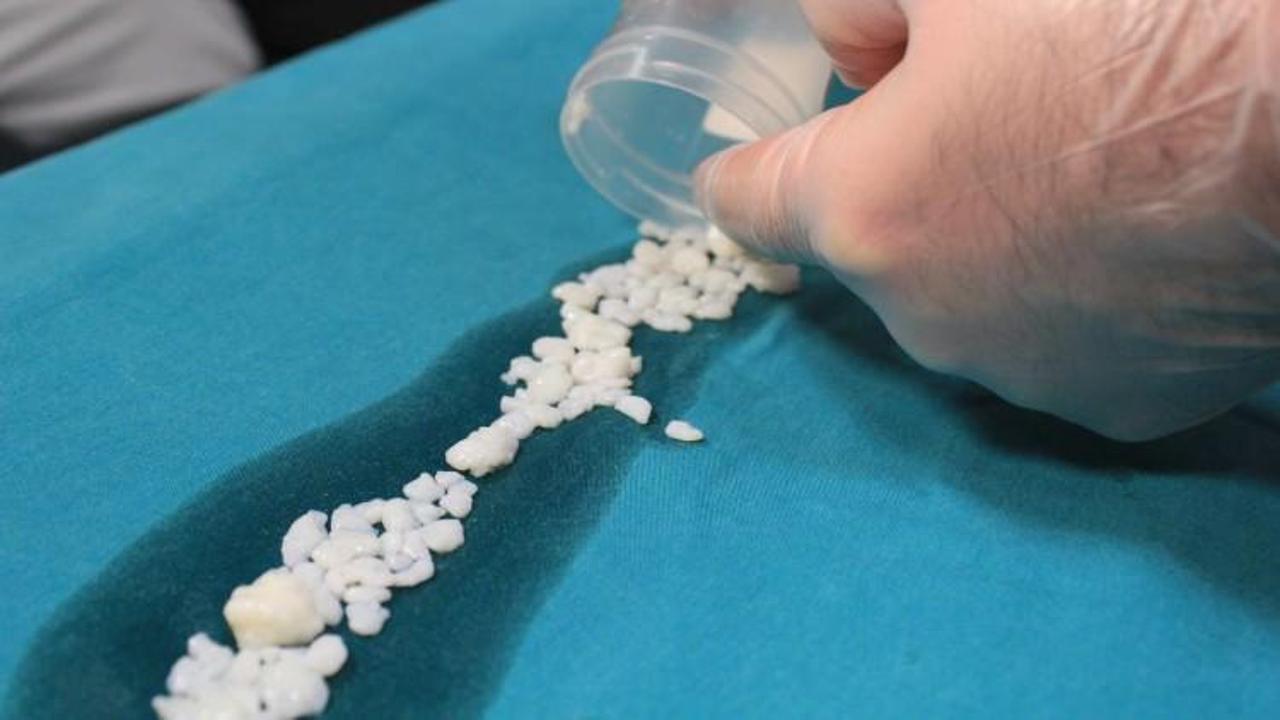 Dizlerinden 967 tane eklem faresi &ccedil;ıktı