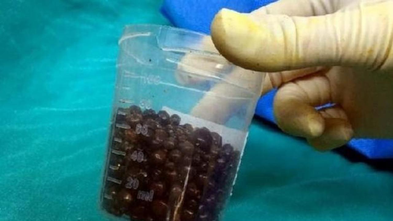 Karın ağrısıyla gitti 550 taş çıkarıldı...