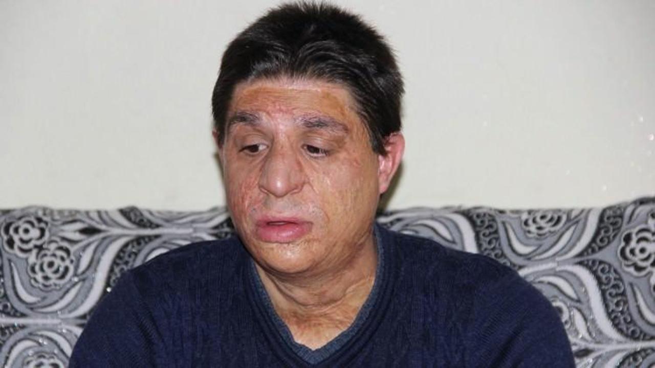 Y&uuml;z&uuml;ne gelen meşale hayatını kararttı