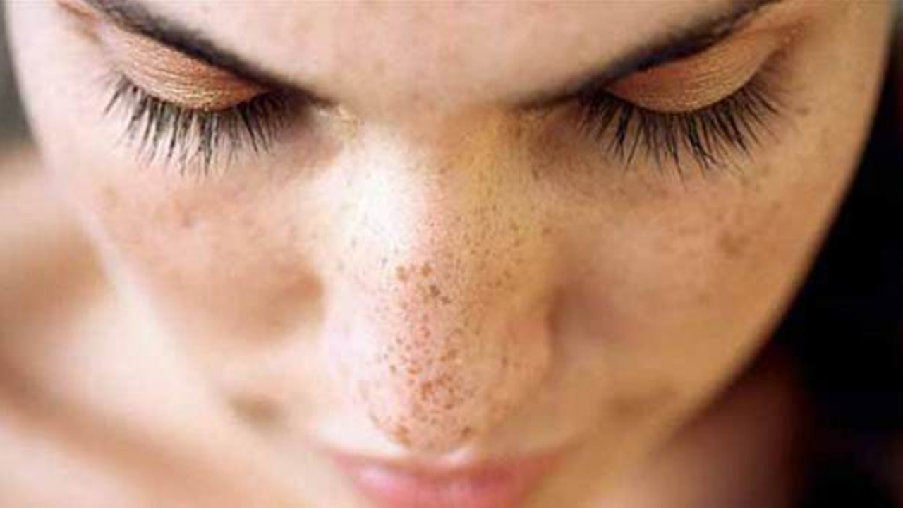 Cilt lekelerinden kurtulmanın yolları!