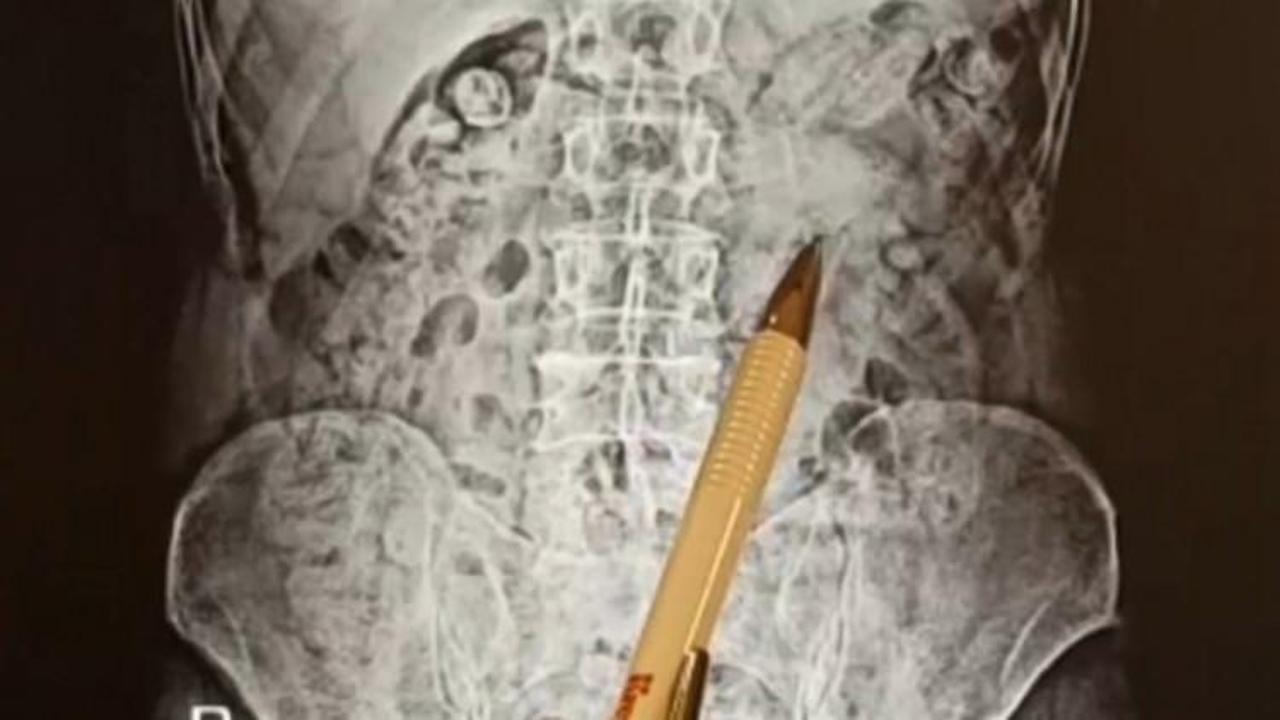 Yok artık! Mide ve bağırsaklarına saklamışlar