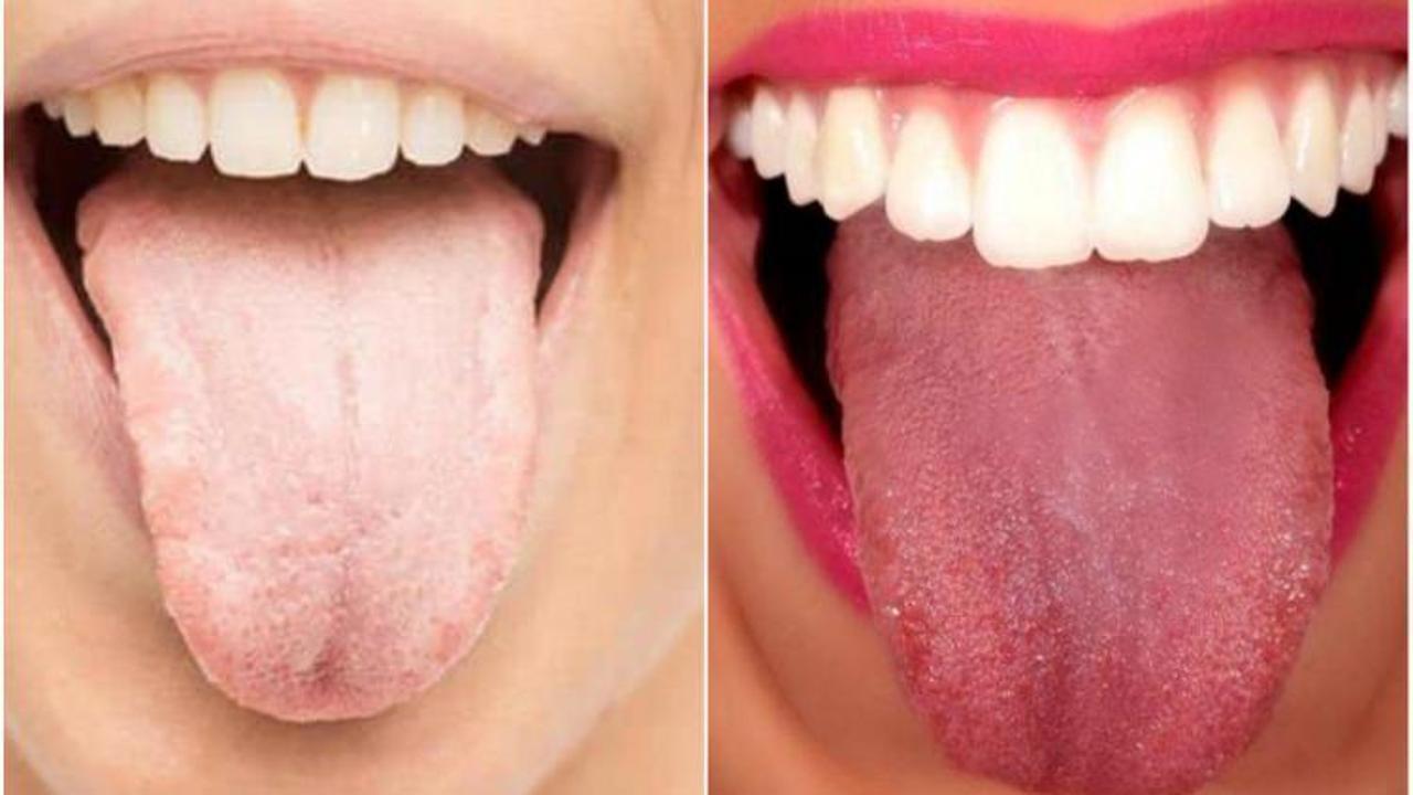 Beyaz dil sorununa doğal çözümler