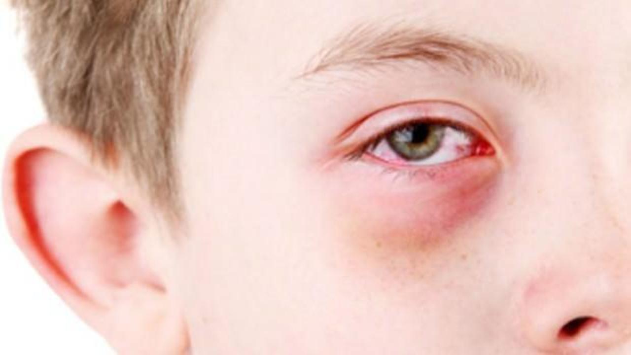 Gözlerinizi bahar alerjisinden korumanın 5 yolu