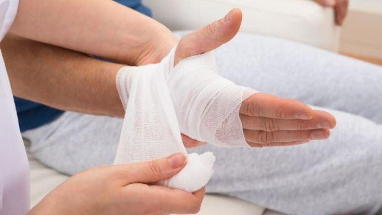 Kızgın yağ yanığına doğal &ccedil;&ouml;z&uuml;mler