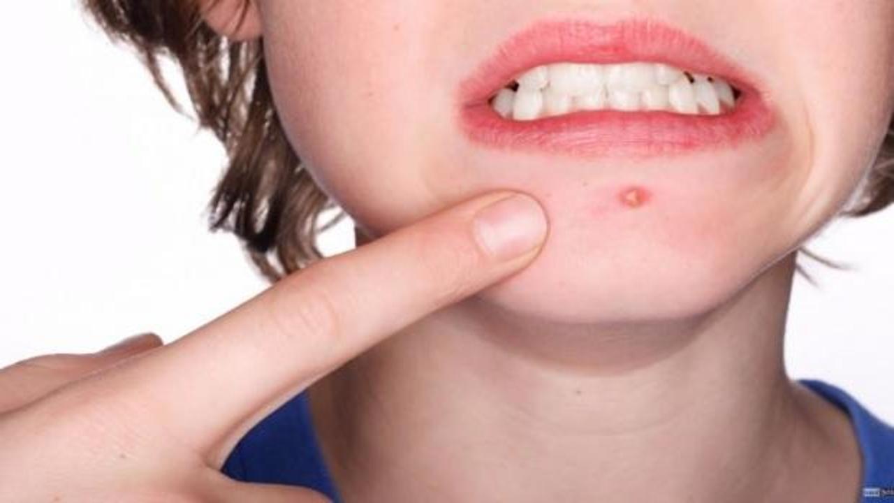 Sivilce oluşumu nasıl engellenir?