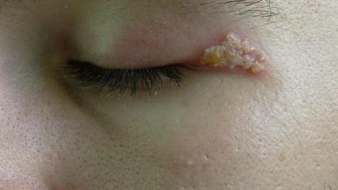 G&ouml;z u&ccedil;uğu nedir? Belirtileri nelerdir? Nasıl ge&ccedil;er?