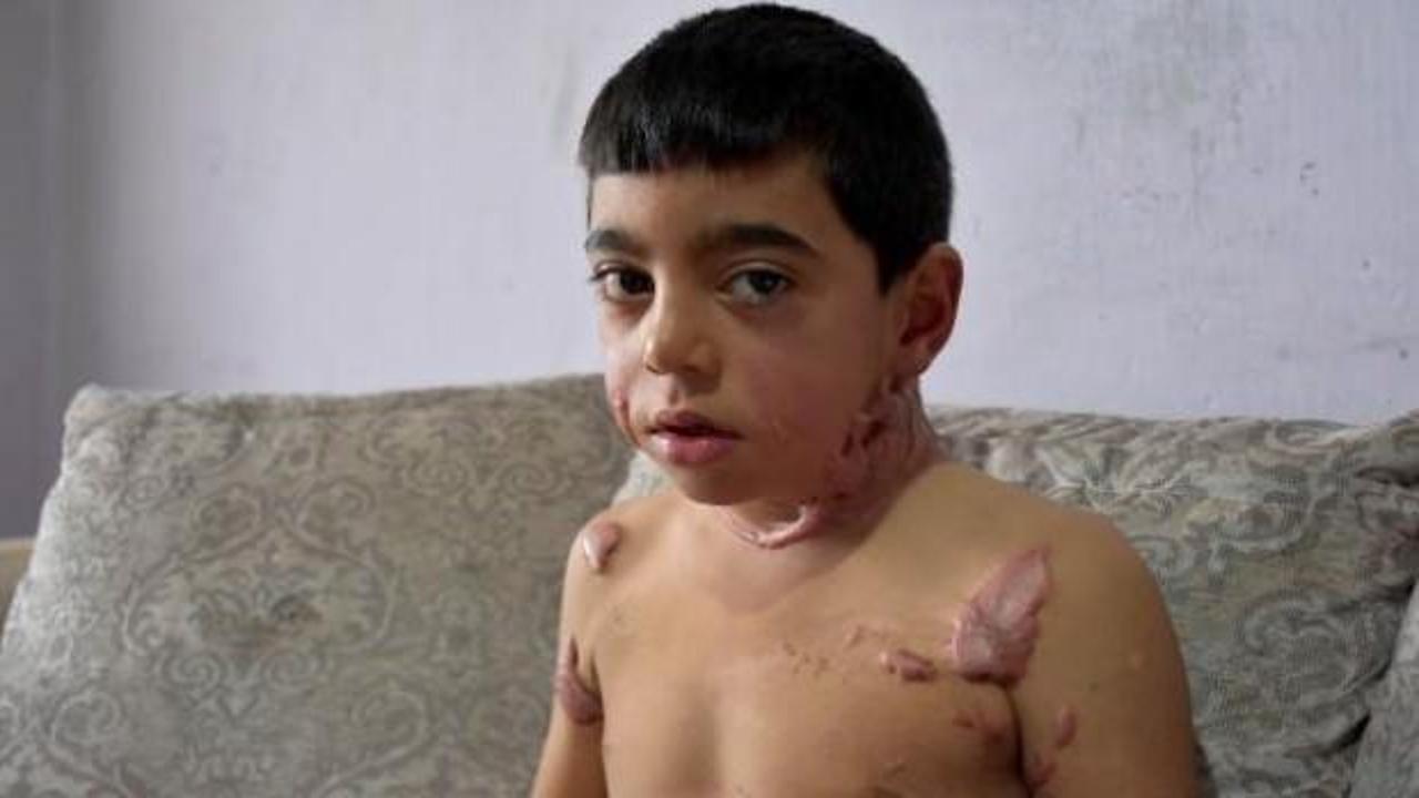 V&uuml;cudundaki yanıklar y&uuml;z&uuml;nden okula gitmiyor