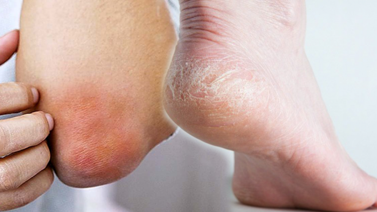 E vitamin eksikliği nedir? E vitamini eksikliğinin belirtileri nelerdir? Hangi besinlerde bulunur?