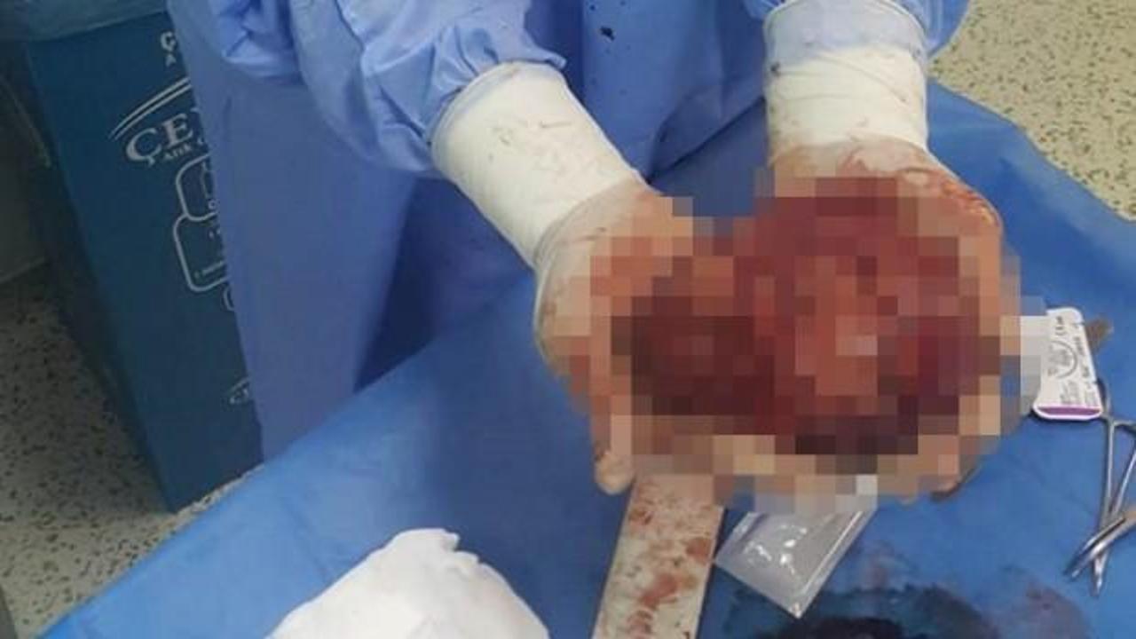 Karnından &ccedil;ıkan şoke etti! Tam 20 santim...