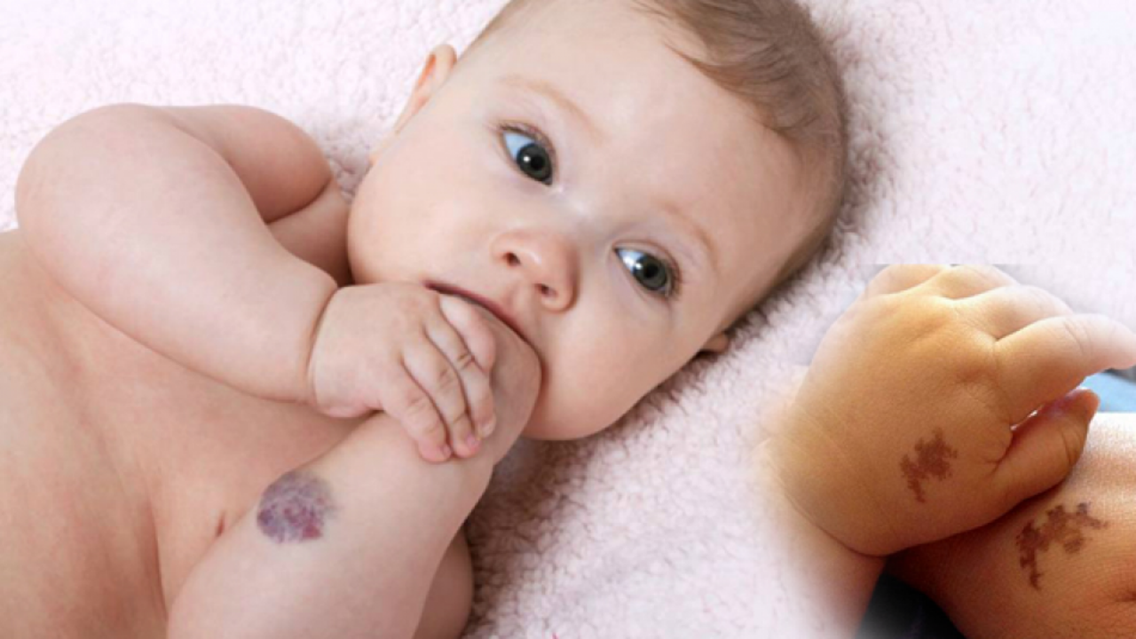 Bebeklerde doğum lekesi neden olur, kalıcı mı? Doğum lekesi çeşitleri neler? Saraçoğlu'ndan kür